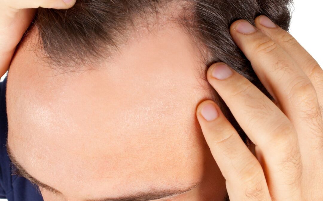 Caduta capelli fare prevenzione: Consigli pratici ed efficaci